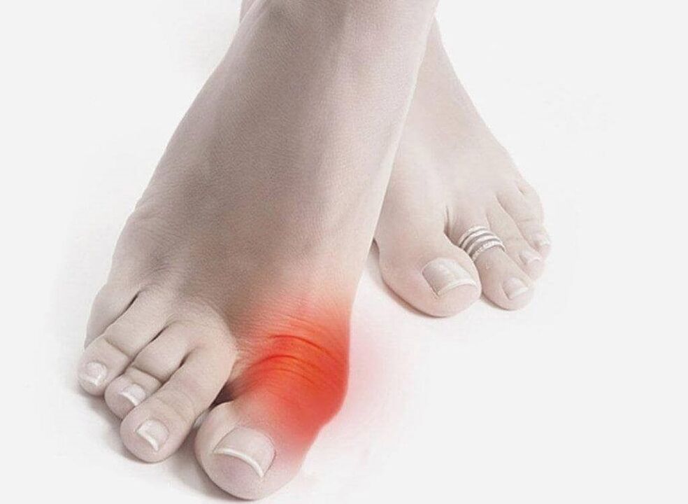 symptômes de la goutte aux pieds